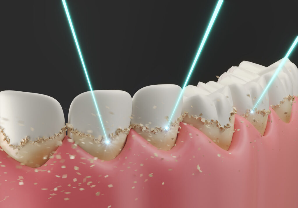 laser dentistry in katy tx at heritage dental