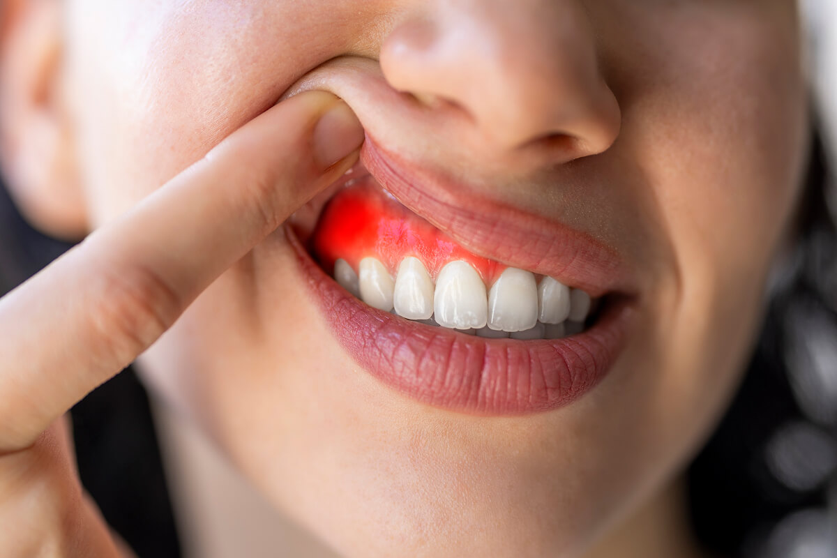 Gum Disease in Katy, TX