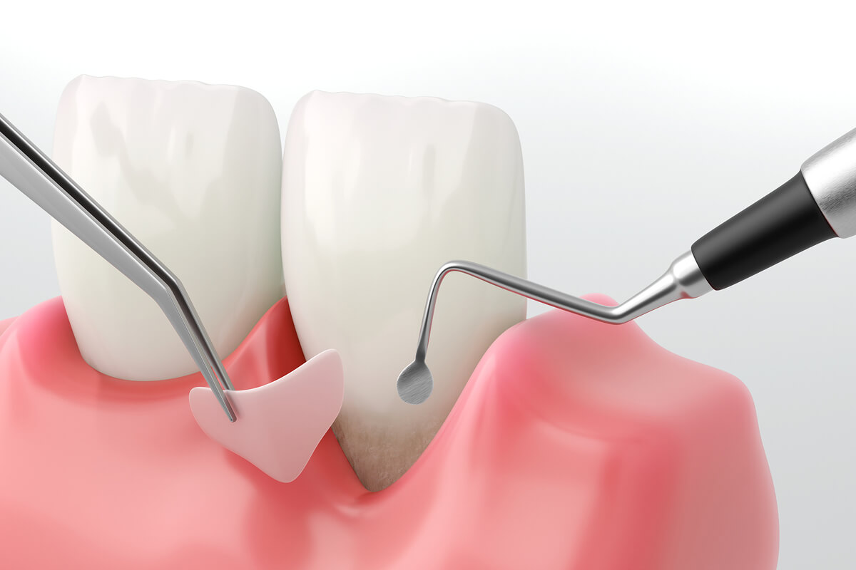 gum disease treatment in Katy, TX